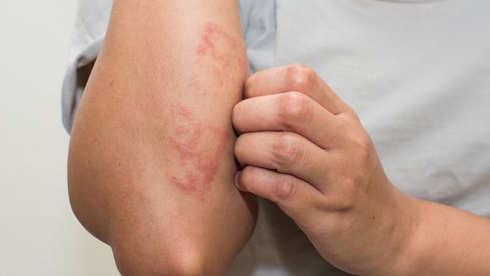 Tratamento Para Alergia a Trigo e Intolerância a Trigo